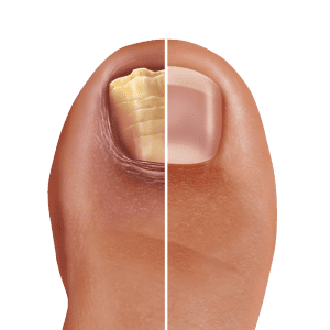 פטרת ציפורניים בבוהן- מה זה?  פטרת ציפורניים היא פטרייה שגורמת לזיהום בציפורניים של הידיים או הרגליים.